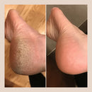 Removedor Elétrico de Rachaduras e Calos para os Pés